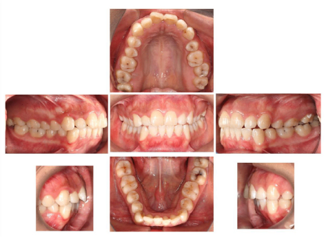 Fotografía dental intraoral