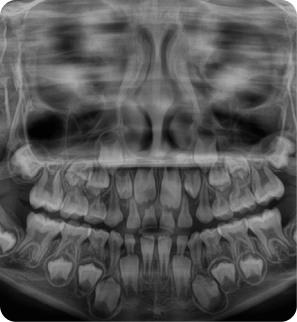 P. Extraoral
